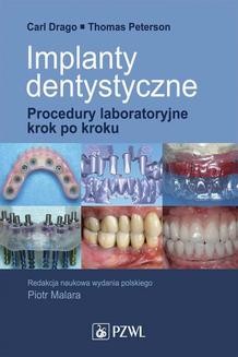 Chomikuj, ebook online Implanty dentystyczne. Procedury laboratoryjne krok po kroku. Carl Drago